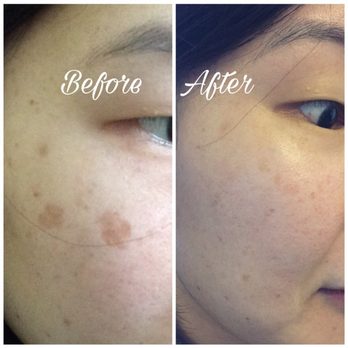 ES Skin Care - Giant sunspots gone with laser removal. - Skin Care Near Me - Buena Park, California