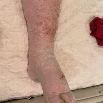 Healthy Lymphatics - Leg before - Massage Near Me - Boone, North Carolina Healthy Lymphatics - Leg before - Massage Near Me - Boone, North Carolina