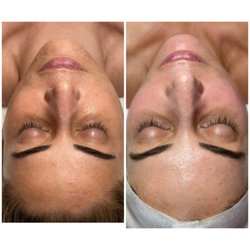 Skin Care By Monik - Micro needling. 26 days apart.