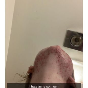 Acne Queen Skin Care - 13 yr old 10 treatments - Skin Care Near Me - Walnut Creek, California Acne Queen Skin Care - 13 yr old 10 treatments - Skin Care Near Me - Walnut Creek, California
