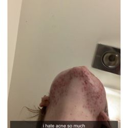 Acne Queen Skin Care - 13 yr old 10 treatments