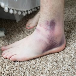 Lets Play Soccer - Just one of multiple injuries that weren't taken seriously.