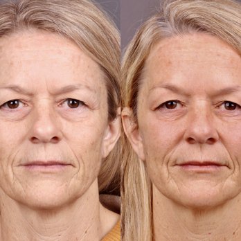 Brandyn Dunn MD - Cheek and chin/jawline filler - Plastic Surgeons Near Me - Newport Beach, California Brandyn Dunn MD - Cheek and chin/jawline filler - Plastic Surgeons Near Me - Newport Beach, California