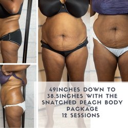 The Peach Bar - Mommy makeover 12 sessions ultrasonic cavitation with wood therapy