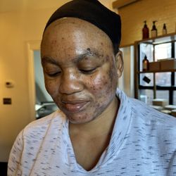 Bold Skin Babe - Acne treatment