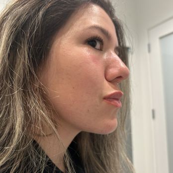 Susan Evans - After: Right - Dermatologists Near Me - Beverly Hills, California Susan Evans - After: Right - Dermatologists Near Me - Beverly Hills, California