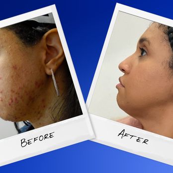 Apex Skin - Acne patient with clear skin after treatment at Apex Dermatology. - Dermatologists Near Me - Hudson, Ohio Apex Skin - Acne patient with clear skin after treatment at Apex Dermatology. - Dermatologists Near Me - Hudson, Ohio