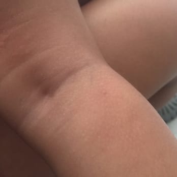 Rose Pest Solutions - Can someone tell me if this looks like Bed bug bites ? - Pest Control Near Me - Chicago, Illinois Rose Pest Solutions - Can someone tell me if this looks like Bed bug bites ? - Pest Control Near Me - Chicago, Illinois
