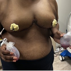 Michelle M Eagan, MD - Breast Reduction!