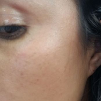 Highly Artistic Surgery - Dark spots/ after - Cosmetic Surgeons Near Me - Poway, California Highly Artistic Surgery - Dark spots/ after - Cosmetic Surgeons Near Me - Poway, California