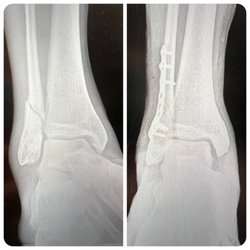 Chase Dahl DPM - Before and After x-rays of oblique fibular fracture