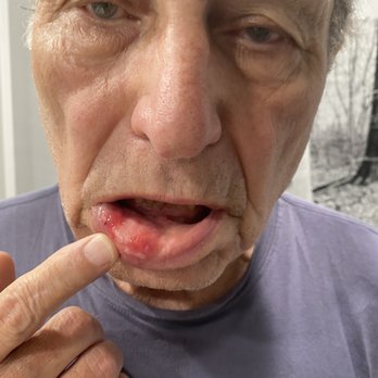 My Pompano Dentist - This is what happened to my husband when Dr. Browne's hand slipped and injured my husband's tooth during an extraction. - General Dentistry Near Me - Pompano Beach, Florida My Pompano Dentist - This is what happened to my husband when Dr. Browne's hand slipped and injured my husband's tooth during an extraction. - General Dentistry Near Me - Pompano Beach, Florida