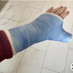 Hand Microsurgery & Reconstruction Orthopaedics - The second incorrect cast that was too tight that had to be cut off