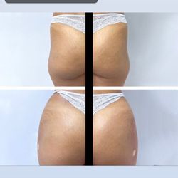 A1 Beauty MedSpa - BBL fillers