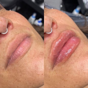 Erin's Beauty Haven - Hyaluron lip Injections. Needle free! - Eyelash Service Near Me - Des Moines, Iowa