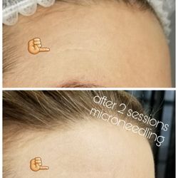 Ibrowcandy - Microneedling after 2 sessions