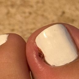 Wound caused by pedicure Wound caused by pedicure