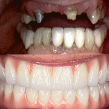 Leonid Fuks, DDS - Before / After - Cosmetic Dentists Near Me - Brooklyn, New York