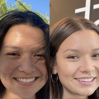 Boost Hydration - Before Boost and after. My smile lines are practically gone and my lips got a little flip up. Love the results. - IV Hydration Near Me - Newport Beach, California Boost Hydration - Before Boost and after. My smile lines are practically gone and my lips got a little flip up. Love the results. - IV Hydration Near Me - Newport Beach, California