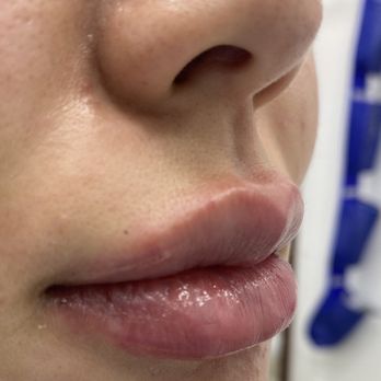 LaserAway - Side view - Laser Hair Removal Near Me - Walnut Creek, California