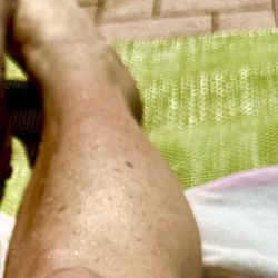 Florida orthopedic Institute - Few days prior to my foot ended up in a sonknjolt plimkgol