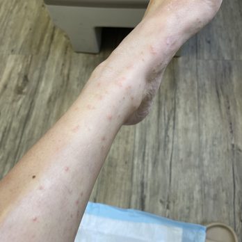 Shipgarten - At the doctor's 2 weeks after the chigger bites from Shipgarten's grass picnic area. Had to get an Rx steroid topical. - The image shows a person's forearm with multiple small red spots and skin irritation, indicating a possible allergic reaction or insect bites. The background includes wooden flooring and a gray medical or clinical surface, suggesting the photo was taken in a healthcare setting. The person's hand is partially visible, and the skin appears slightly swollen and irritated. - Beer Gardens Near Me - Mclean, Virginia