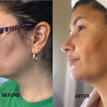 Red Rabbit Aesthetics - My before and After Ylift for $2400 - Medical Spas Near Me - Red Bank, New Jersey Red Rabbit Aesthetics - My before and After Ylift for $2400 - Medical Spas Near Me - Red Bank, New Jersey