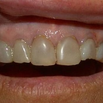 Mark A Barber, DDS - As teeth age, they wear and chip, and can become darker. - General Dentistry Near Me - Port St Lucie, Florida Mark A Barber, DDS - As teeth age, they wear and chip, and can become darker. - General Dentistry Near Me - Port St Lucie, Florida