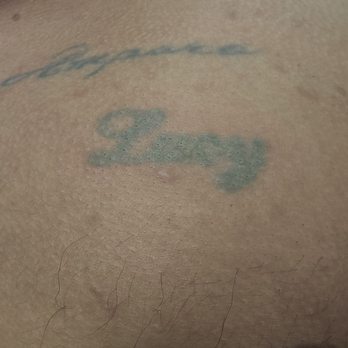 LaserAway - This is before the 10 treatments the recommended for $1,400.00. They told me thats all I needed, every 8 weeks. - Medical Spas Near Me - Los Angeles, California LaserAway - This is before the 10 treatments the recommended for $1,400.00. They told me thats all I needed, every 8 weeks. - Medical Spas Near Me - Los Angeles, California