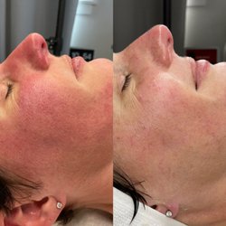 The Untamed Society - Treating sensitive skin- before and after only 1 enzyme