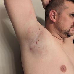 Utah Valley Dermatology - Post miraDry procedure. Bruised and swollen for the first couple days. Worth it though.