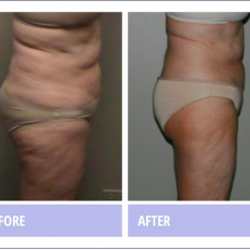 Best Light Laser Fat Reduction