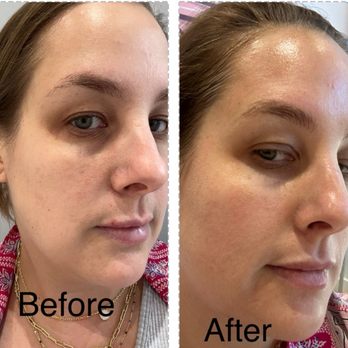 LaserAway - Before and after - Tattoo Removal Near Me - Washington DC, District of Columbia