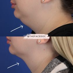 Andrew Campbell, MD - Sculpted Jawline done with an in-office procedure. Natural, refined, and stunning.