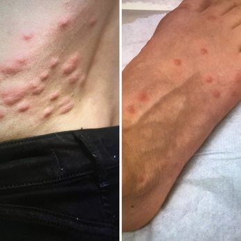 Courtyard by Marriott - This is what happens when you stay at the Courtyard in Cancun. Went to the ER and confirmed it's bed bugs. - Hotels Near Me - Cancún, ROO