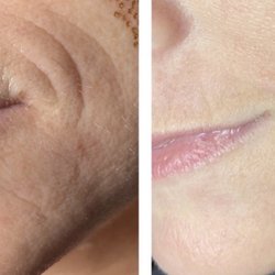 Kenzie Bertrand - Micro & More - Plasma skin tightening!