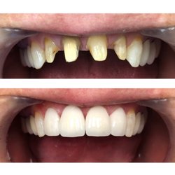 Stephen P Hahn, DDS - 4 anterior porcelain crowns