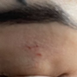 Cut on my eyelid Cut on my eyelid