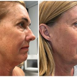 Love Your Body - Icoone Face results: 10 sessions, 64 years old