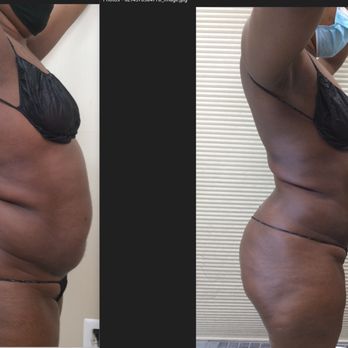 PS Contouring - Before and After - Body Contouring Near Me - Mclean, Virginia PS Contouring - Before and After - Body Contouring Near Me - Mclean, Virginia