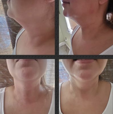 Chin & Neck Treatments - Body Sculpting, Advanced Skin Specialist. Health and Wellness. Fully certified and insured.