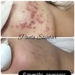 Secrets of Beauty Skin & Body - Combination of vipeel and deep pore cleansing #laserfacial #vipeel #facemassage