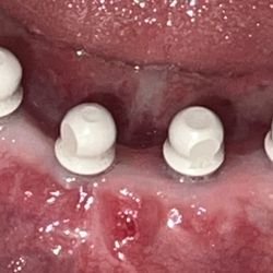 Carlos Abreu - Tongue bumper