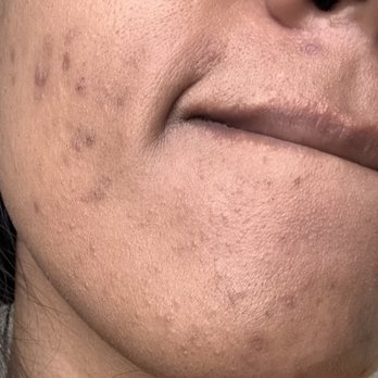 LaserAway - Tattoo Removal Near Me - Naperville, Illinois