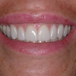 Precision Arts Dental Associates - After. Conservative preparation, pressable ceramic veneers. (dentistry performed by Dr. Sullivan)