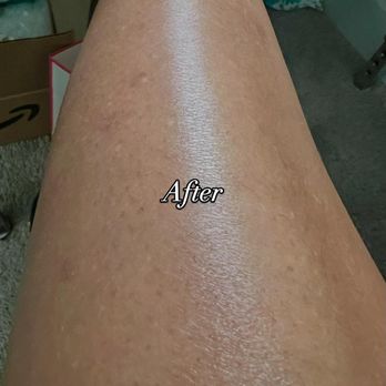 Ink Reclaimed By Lana - After pic of my clients age spots. This is her 1st session, it normally takes 3 sessions for optimal results. - Permanent Makeup Near Me - McDonough, Georgia Ink Reclaimed By Lana - After pic of my clients age spots. This is her 1st session, it normally takes 3 sessions for optimal results. - Permanent Makeup Near Me - McDonough, Georgia
