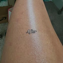 Ink Reclaimed By Lana - After pic of my clients age spots. This is her 1st session, it normally takes 3 sessions for optimal results.