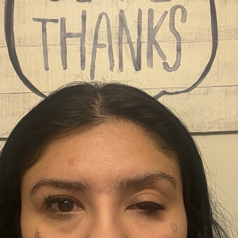 Td Aesthetics - My eye progressively got worse ! - Medical Spas Near Me - Los Angeles, California Td Aesthetics - My eye progressively got worse ! - Medical Spas Near Me - Los Angeles, California