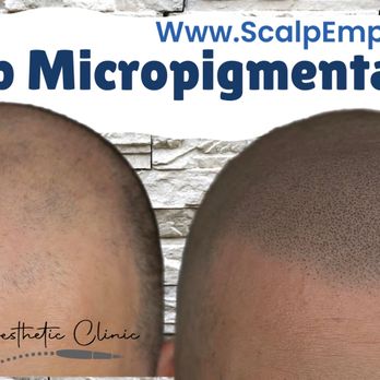 Scalp Empire Studio - SMP - Hair Loss Centers Near Me - Midlothian, Virginia Scalp Empire Studio - SMP - Hair Loss Centers Near Me - Midlothian, Virginia