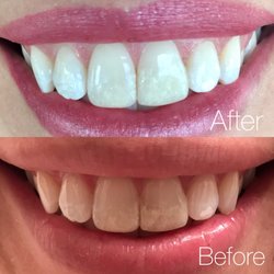 Intentional Smiles - Dr Barton did an incredible job  color matching my front tooth. I'm thankful for his attention to detail and thoughtful planning!!